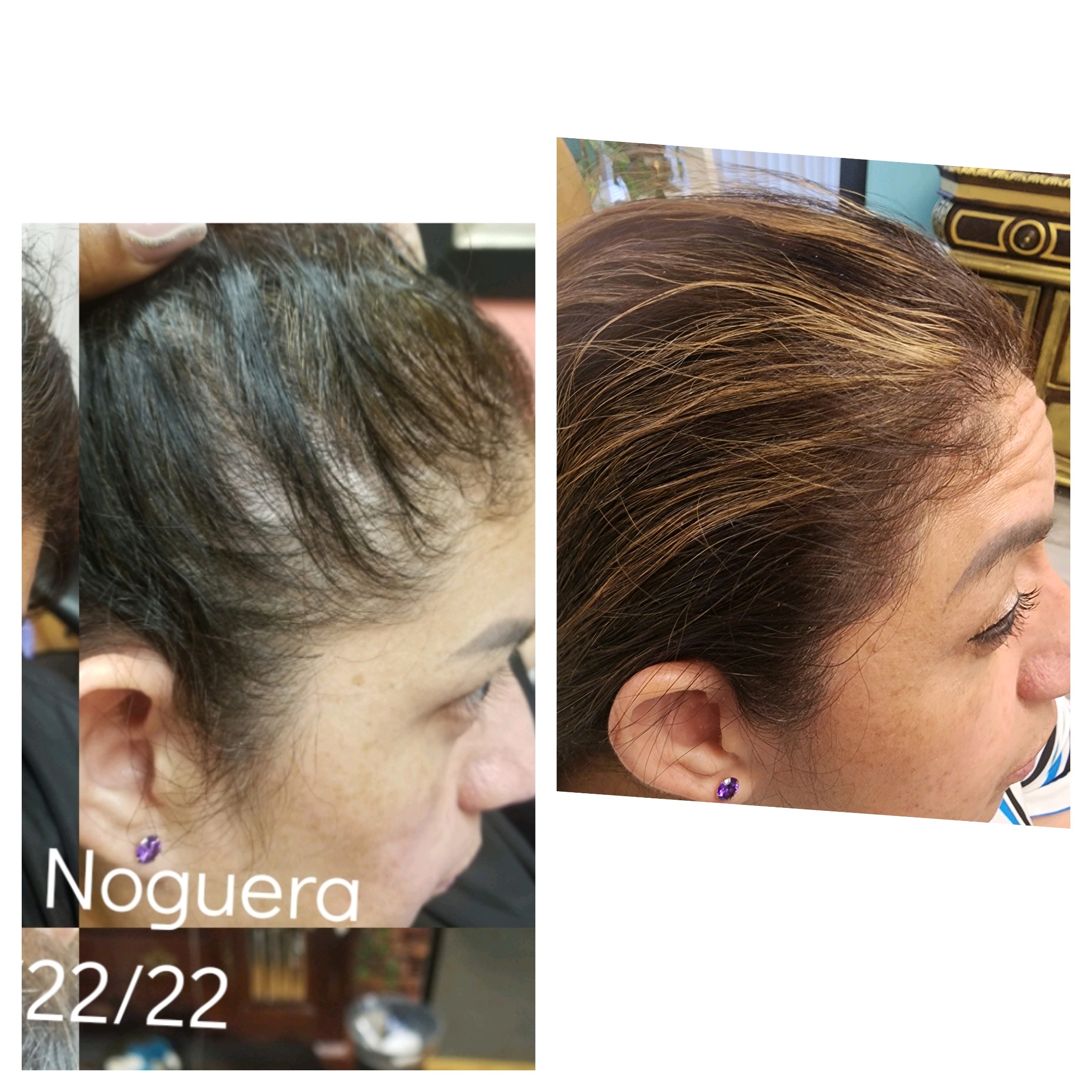 Hair Regrowth Treatment