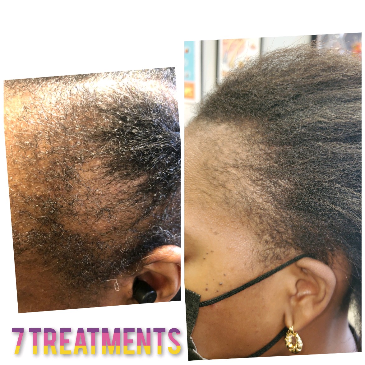 Hair Regrowth Treatment