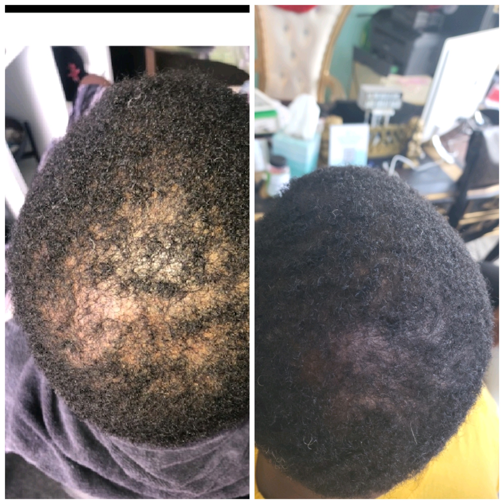 Hair Loss Treatment