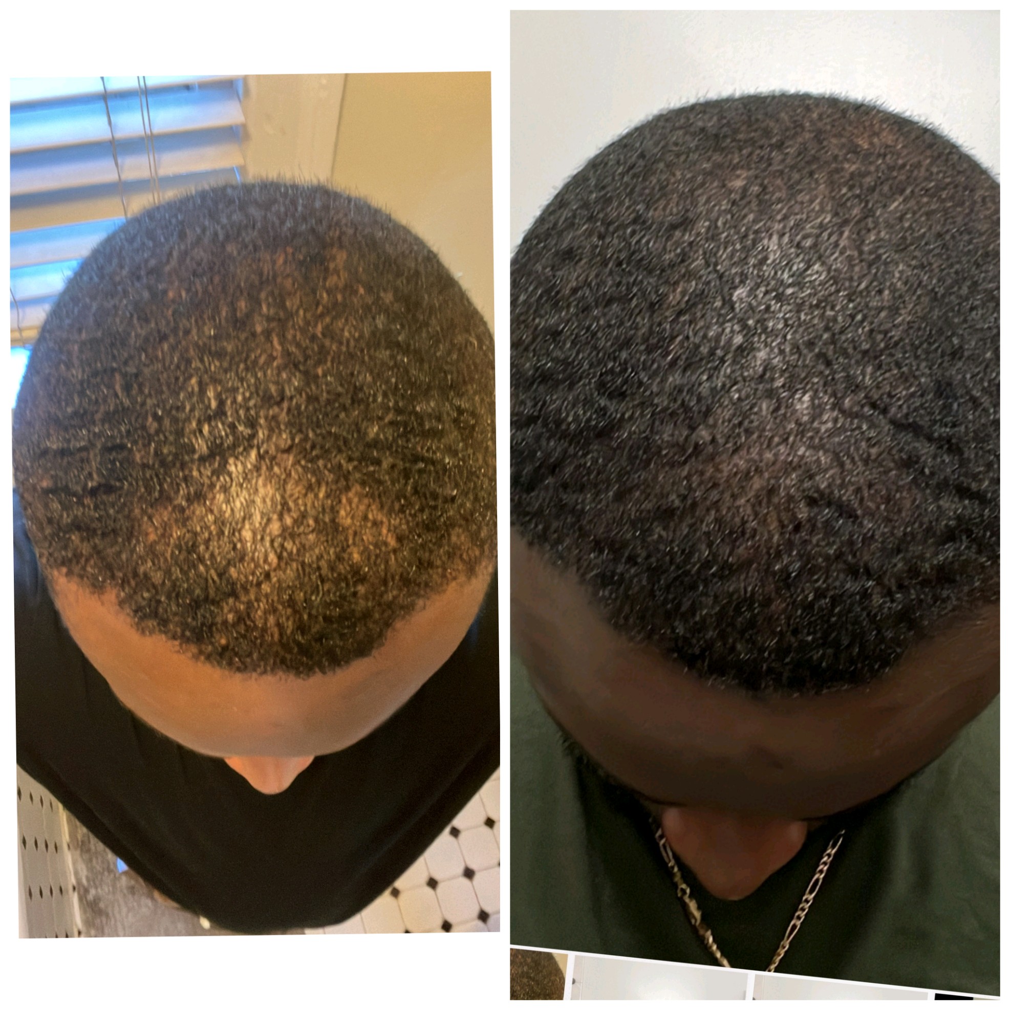 Hair Restoration